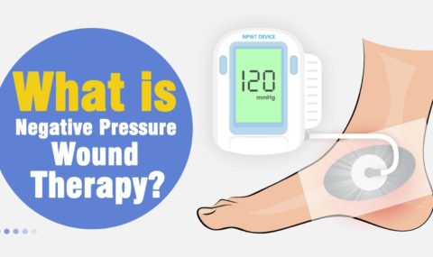 0817 Negative Pressure Wound Therapy-恢复的