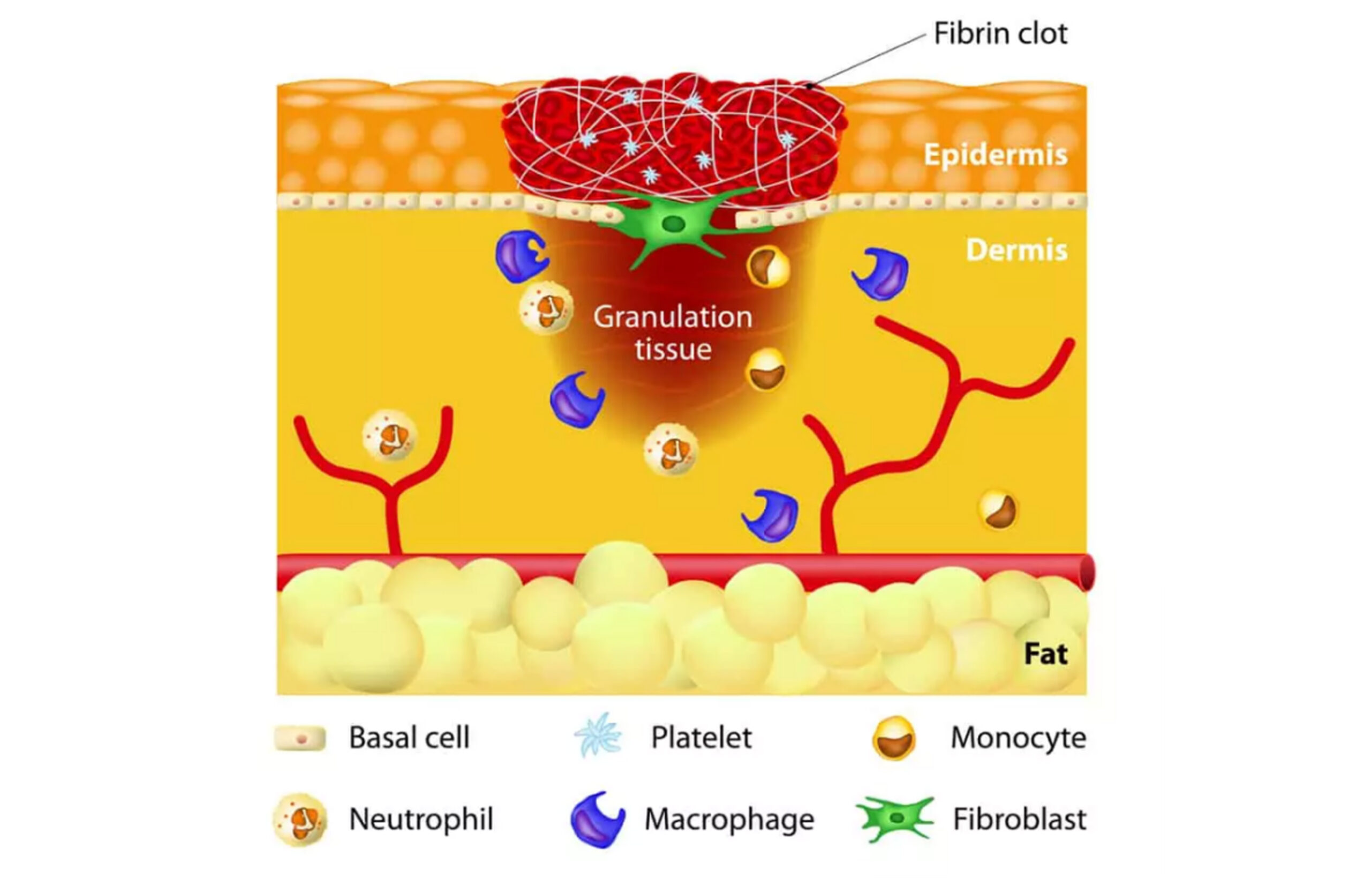 granulation tissue