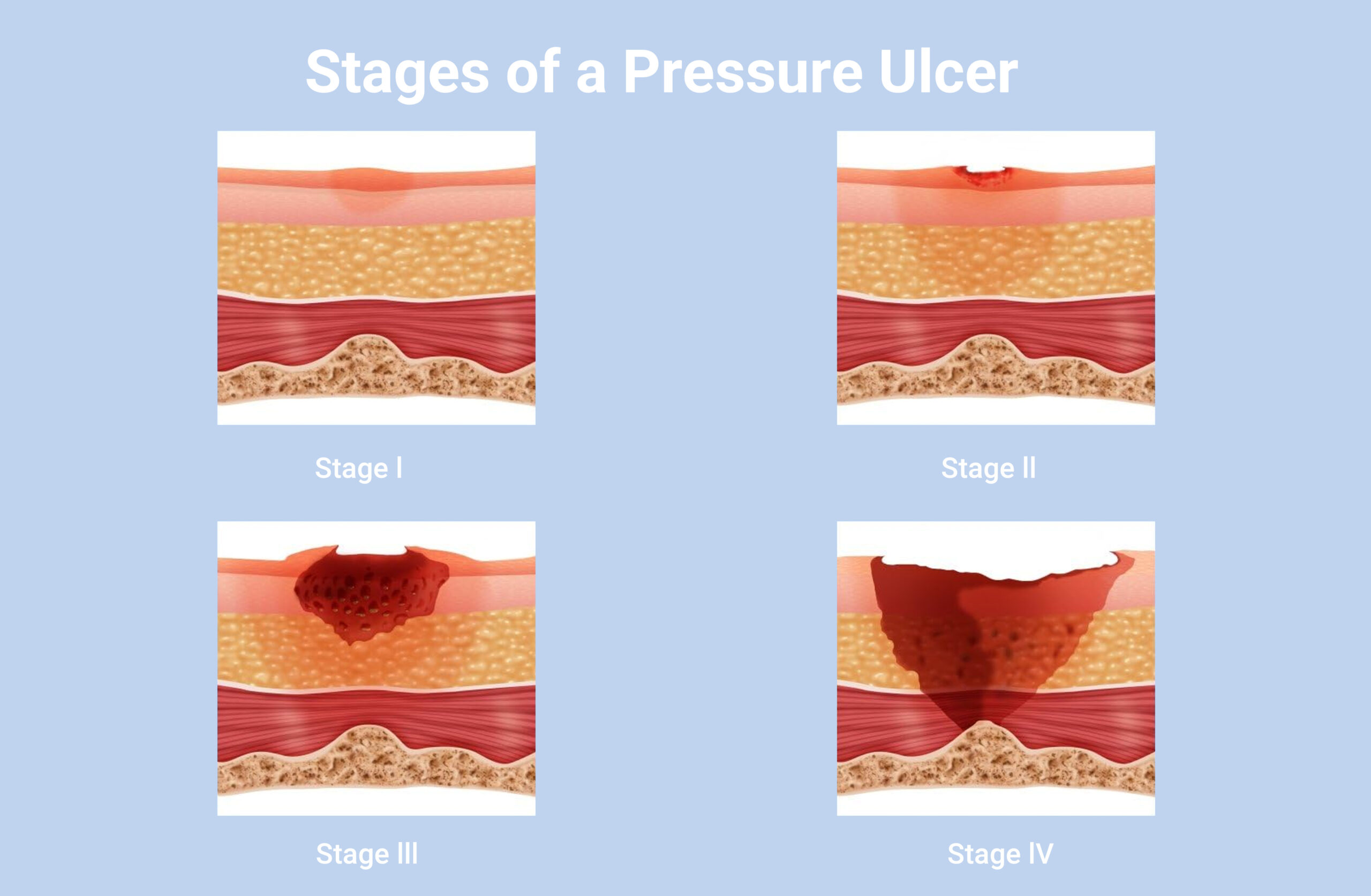 How to Recognize Pressure Ulcers