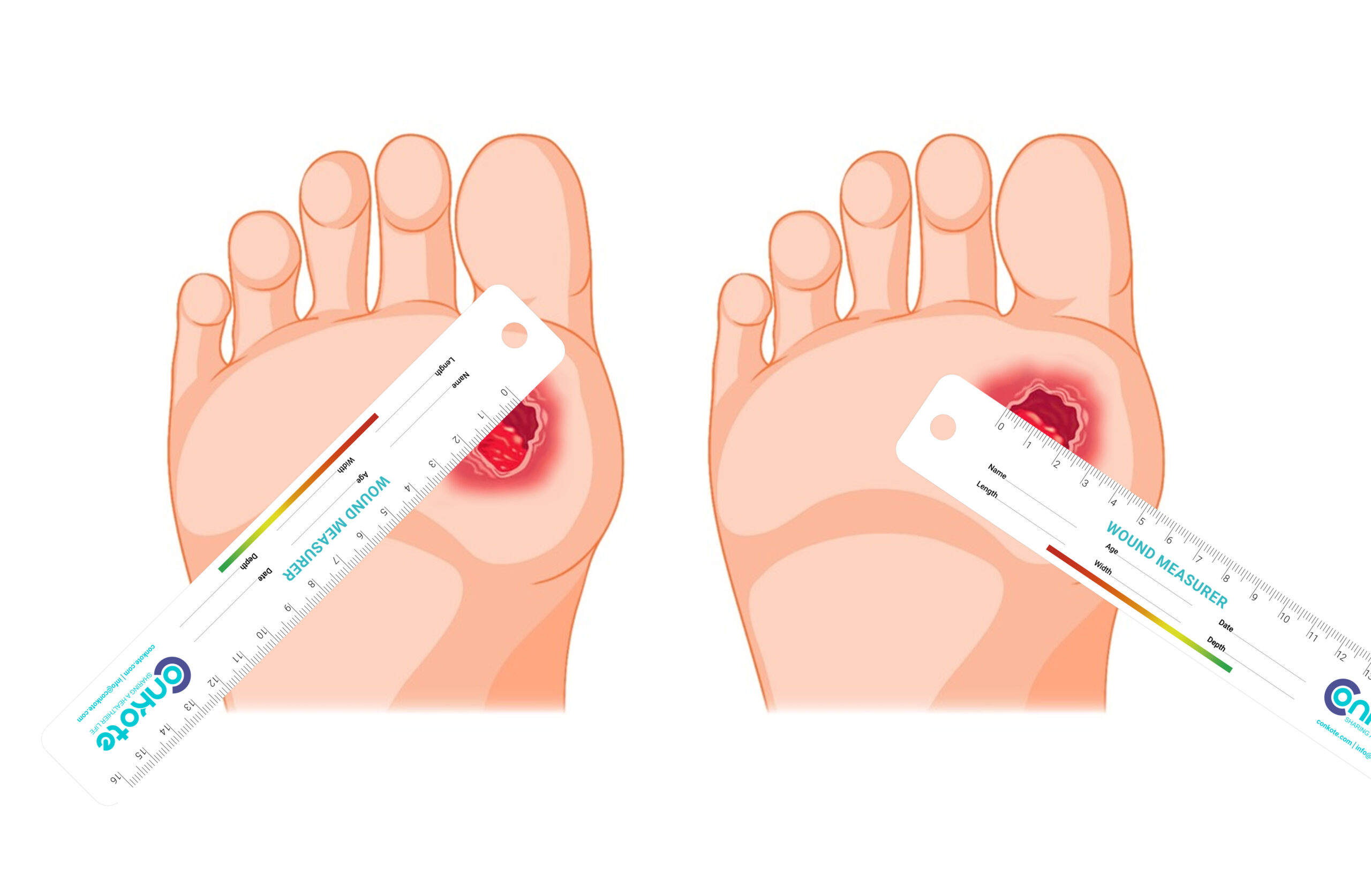 Methods for Measuring a Wound