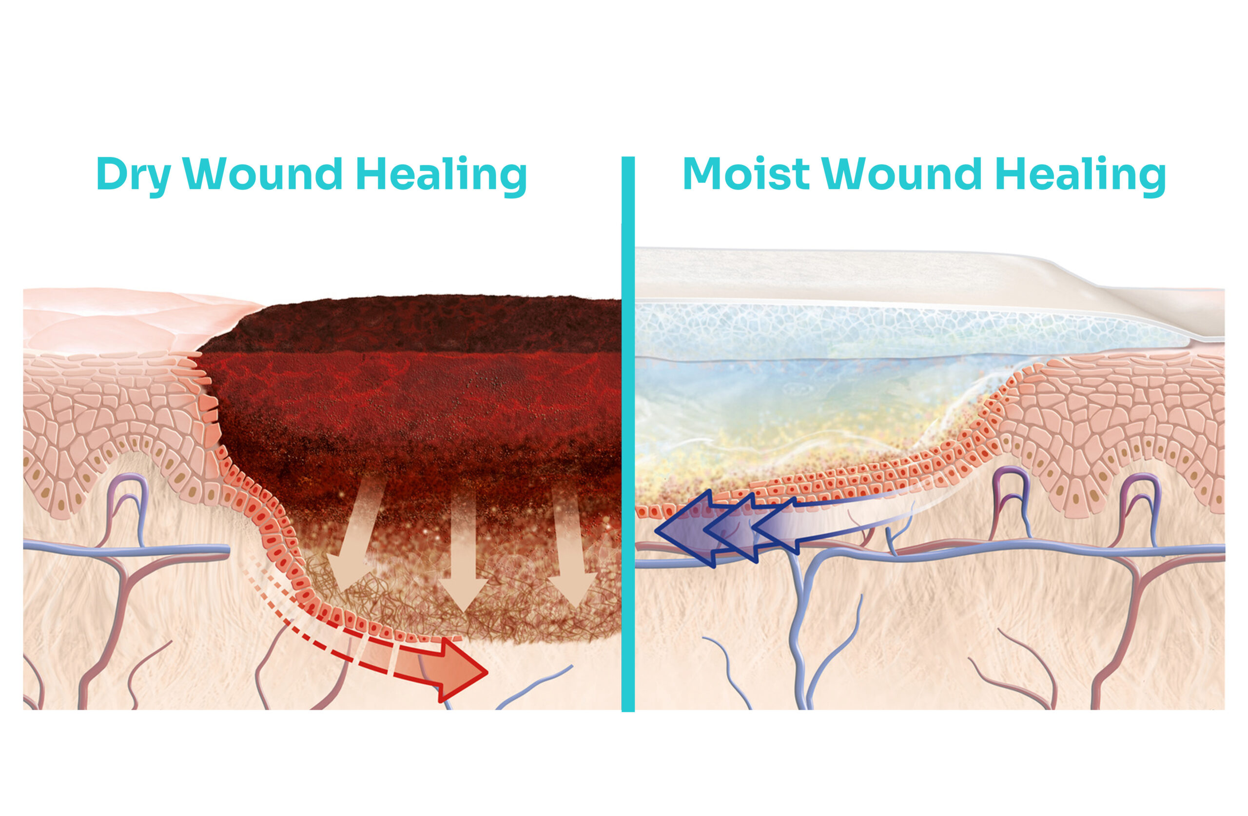 Moist Wound Healing vs. Dry Wound Healing